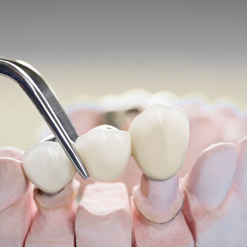Types of dental bridges