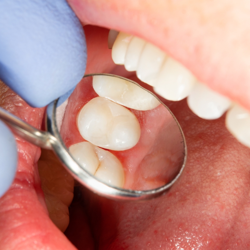 Composite fillings advice