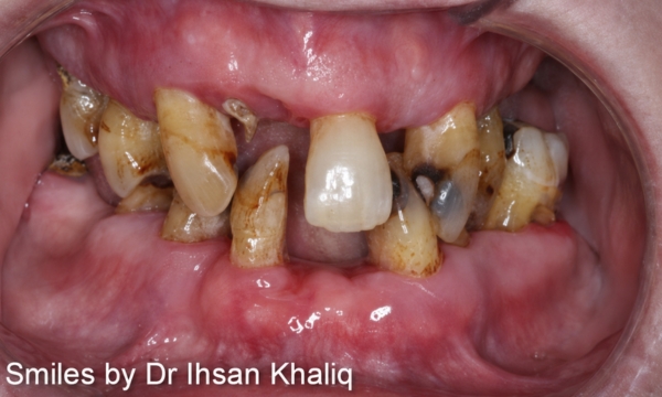 Smile Makeover Case 1 before