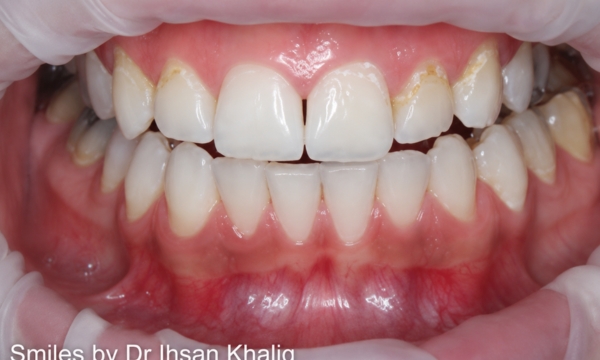 Veneers Case 1 before