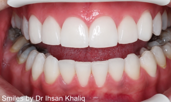 Veneers Case 1 before