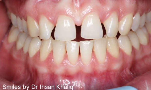 Invisalign® Case 1 before