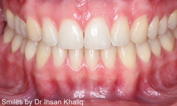 Invisalign® Case 1 before