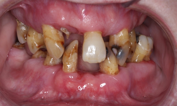 Dental implants - Case 1 before