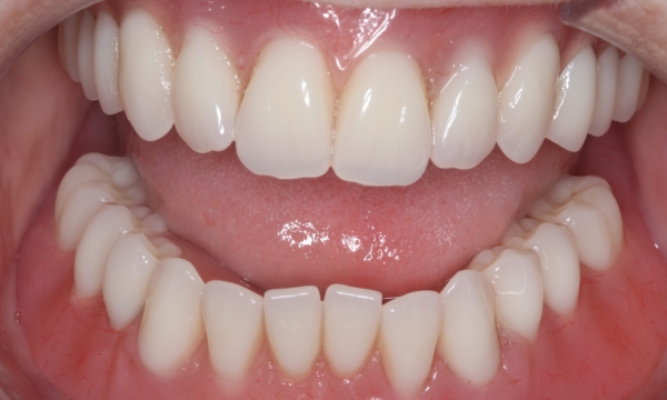 Dental implants - Case 1 after