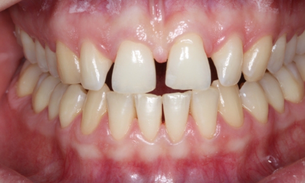 Invisalign® - Case 1 before