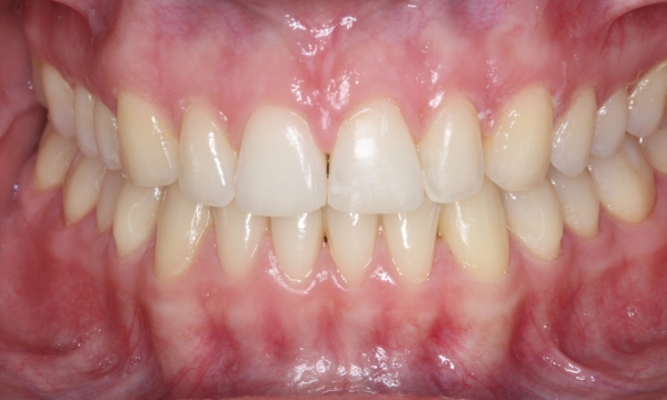 Invisalign® - Case 1 after