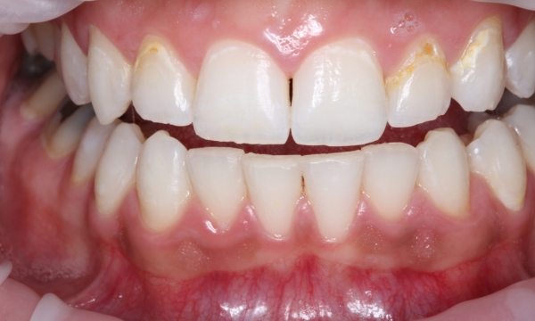 Porcelain Veneers - Case 1 before