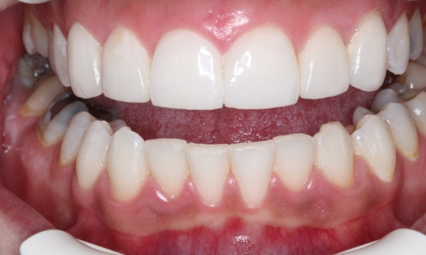 Porcelain Veneers - Case 1 after